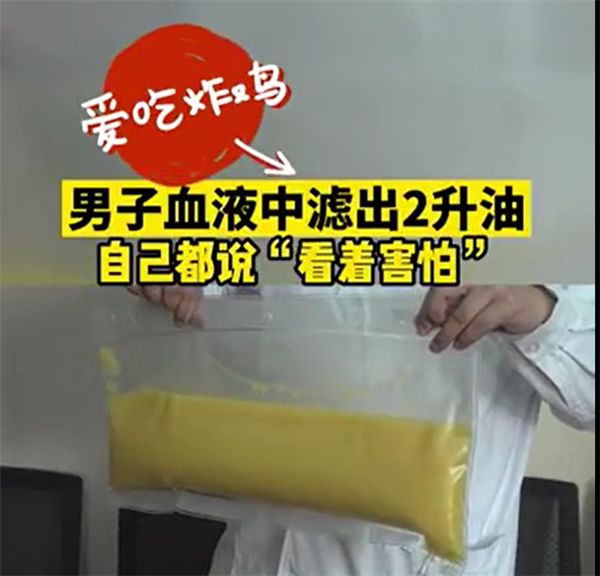 274斤男子血管抽出2升“油”!血管怎么变成了“油管”? - v2ra小站