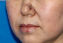 女子鼻子长疙瘩以为黑头竟是癌症：类似状况要尽早就医 - v2ra小站