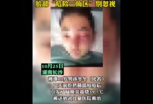 别乱抠痘！13岁男孩挤痘引发脑膜炎：面部“危险三角区”不要随便碰 - v2ra小站