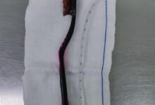 小伙清理舌苔误吞18厘米长牙刷:斜插入肠道 医生做胃镜取出 - v2ra小站