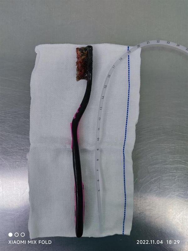 小伙清理舌苔误吞18厘米长牙刷:斜插入肠道 医生做胃镜取出 - v2ra小站
