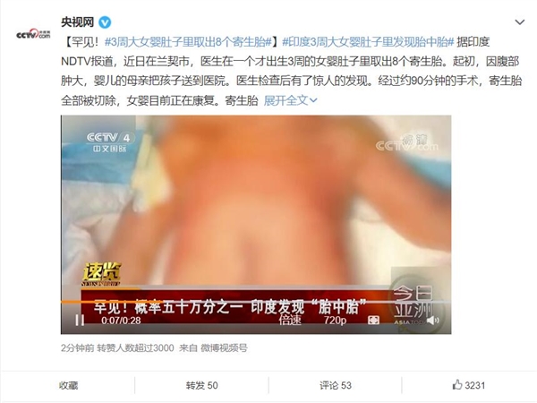 罕见!3周大女婴肚子里取出8个寄生胎 - v2ra小站