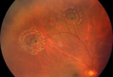 00后考研女生用眼过度致视网膜裂孔:专家科普如何防治 - v2ra小站