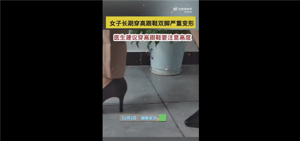 好看也痛苦！女子长期穿高跟鞋致双脚变形 治疗晚了走路都困难 - v2ra小站