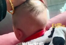 家长注意！宝宝剃胎毛后局部毛囊闭合难长头发：或需植发治疗 - v2ra小站