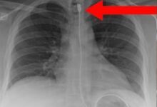 女子呼吸困难紧急就医 X光发现体内有1米长iPhone数据线 - v2ra小站