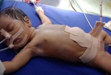 印度一女婴体内有8个寄生胎让医生惊叹：全球仅有约200例 - v2ra小站