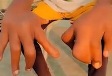 男孩患罕见病长61厘米巨手如“绿巨人”！医生诊断巨指症 - v2ra小站