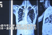 男子患怪病身高从1米8变1米7 医生:首次碰到 - v2ra小站