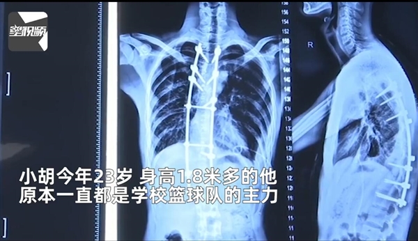 男子患怪病身高从1米8变1米7 医生:首次碰到 - v2ra小站