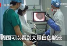 小伙误吞牙签:十几天暴瘦40斤 一吃饭就吐 - v2ra小站
