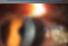 女子连戴10年隐形眼镜角膜受损变色:送医时视力已不足0.1 - v2ra小站