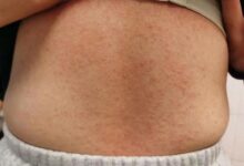 女子混吃7种感冒止咳药全身长满脓疱：医生科普乱吃药伤害有多大 - v2ra小站